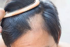 man brushing hair to show scalp