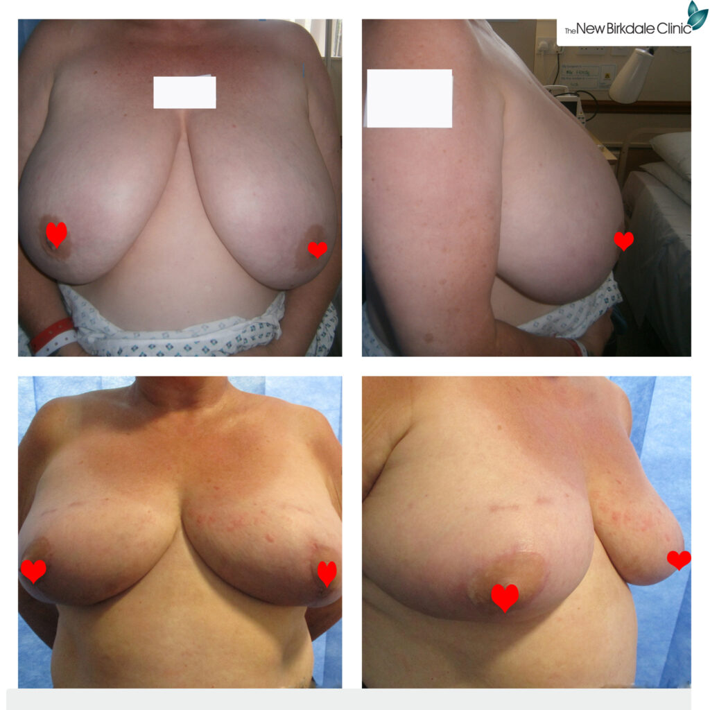 four-before-and-after-pictures-of-breast-reduction-surgery