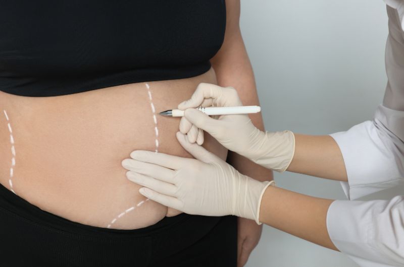 liposuction-sites