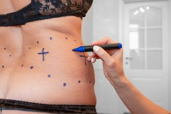 Pre op liposuction
