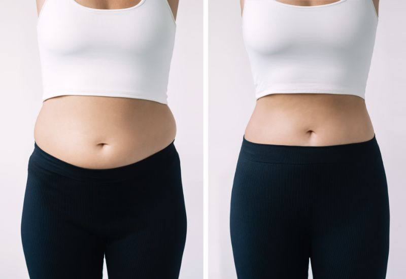 Before and after liposuction