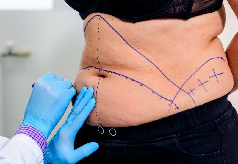 Pre tummy tuck surgery