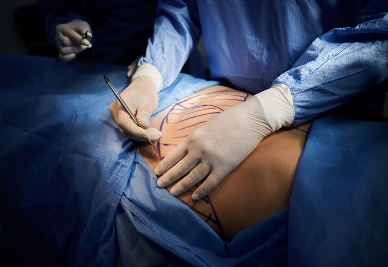 Tummy tuck surgery