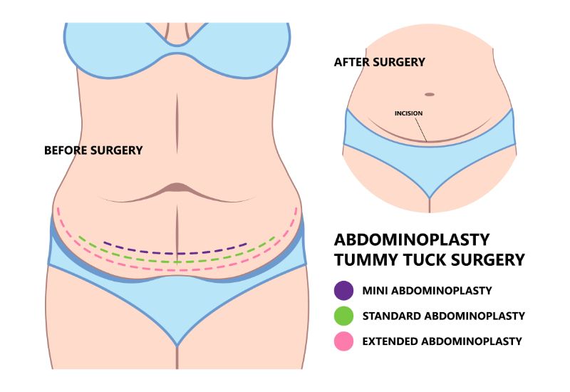 illustrated graphic of tummy tuck scars