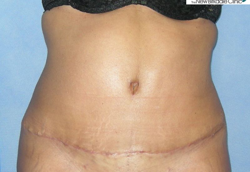 post surgery tummy tuck scar