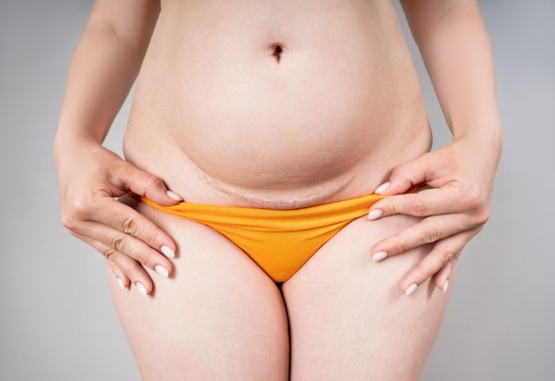 tummy tuck scars