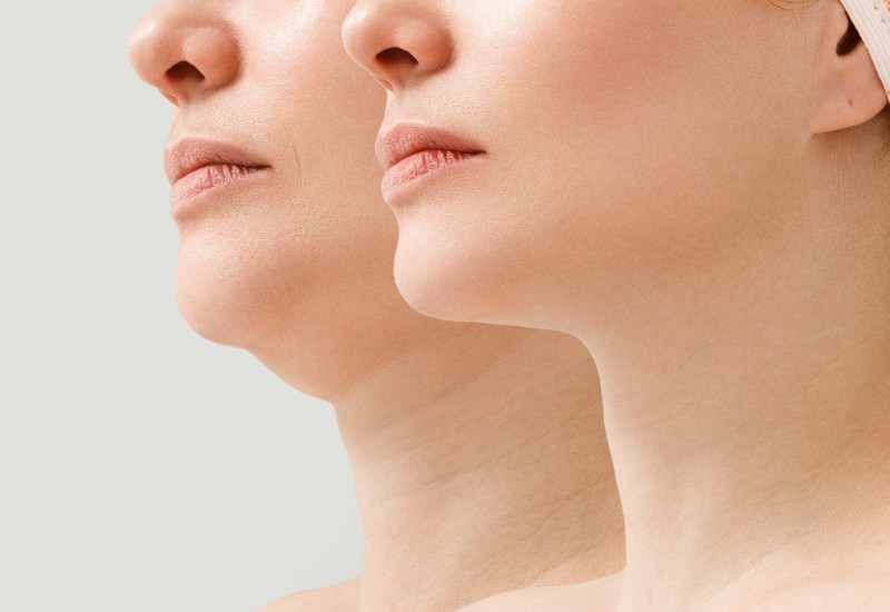 types of facelift - feature image