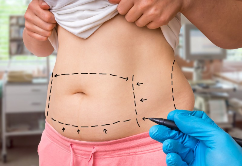 tummy tuck procedure