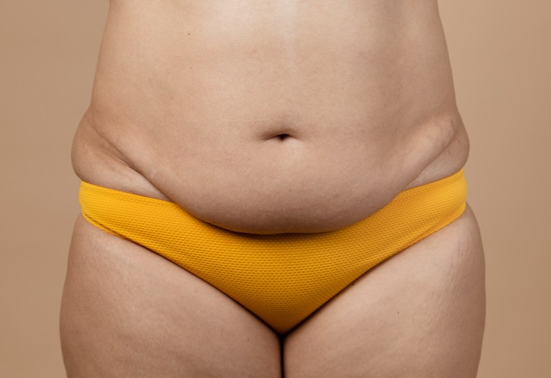 candidate for a tummy tuck surgery