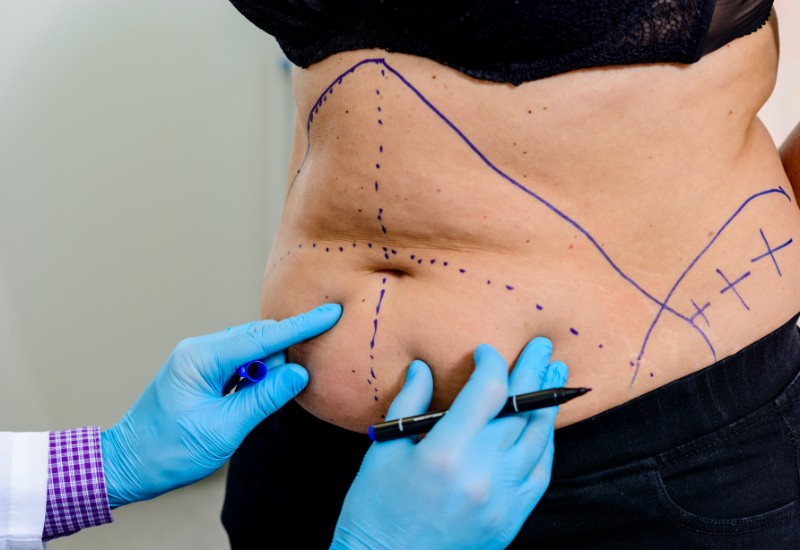 preparing for a tummy tuck