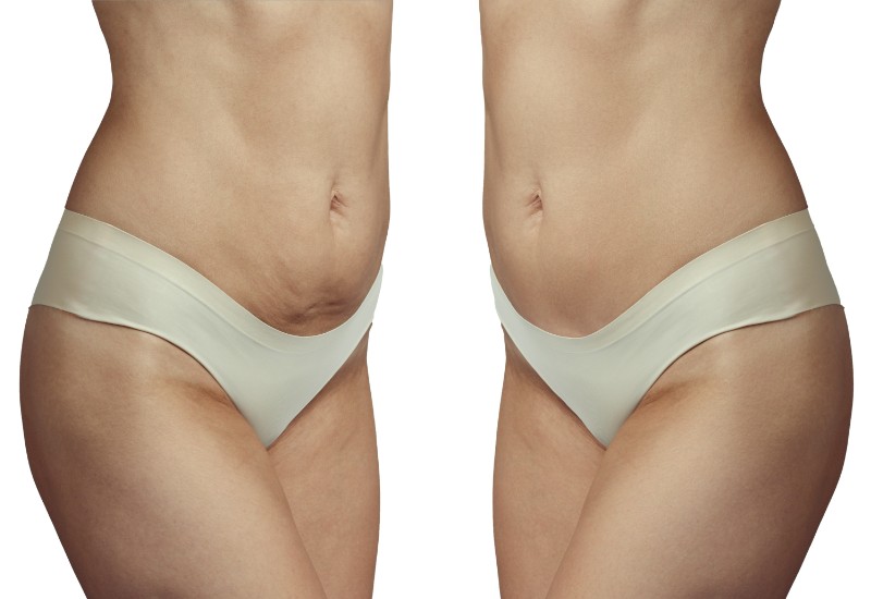 abdominoplasty