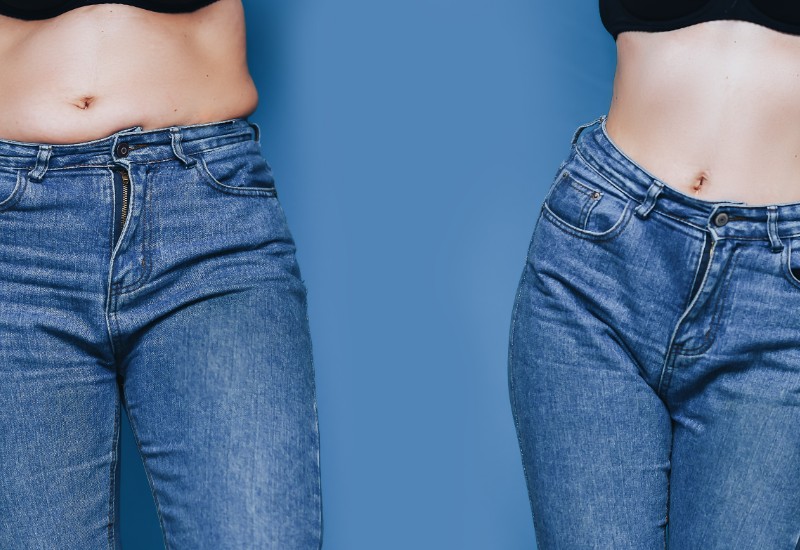 tummy tuck before and after