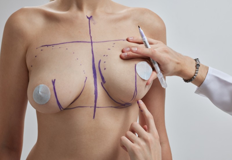 breast augmentation