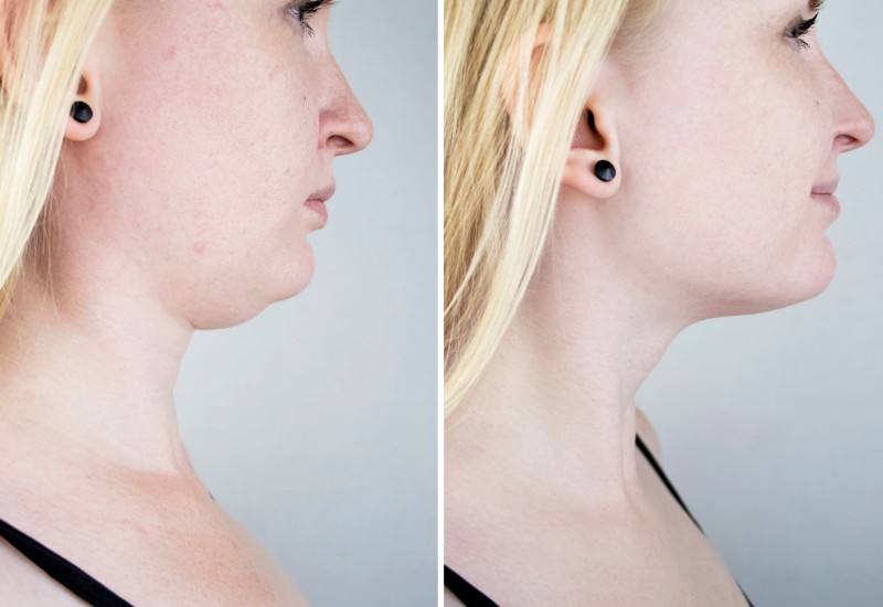 before and after chin surgery