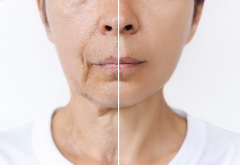 facelift
