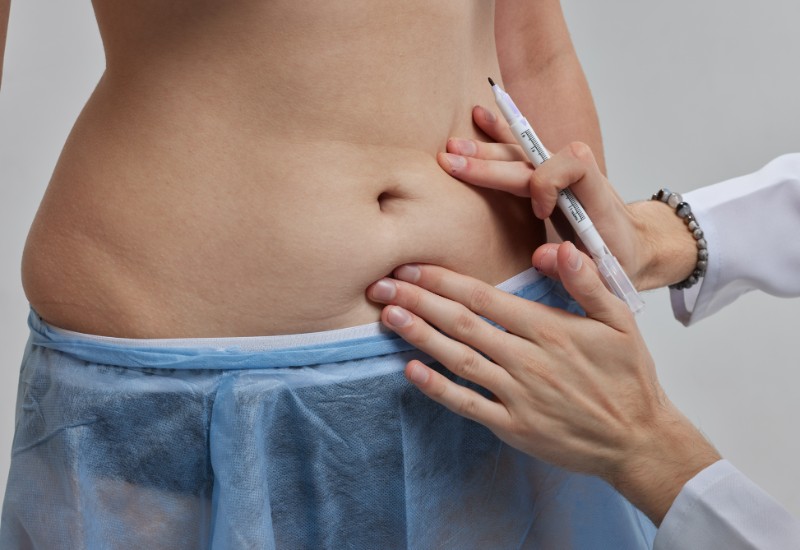 tummy tuck vs liposuction feature image