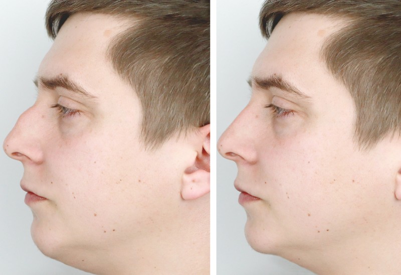 before and after rhinoplasty.