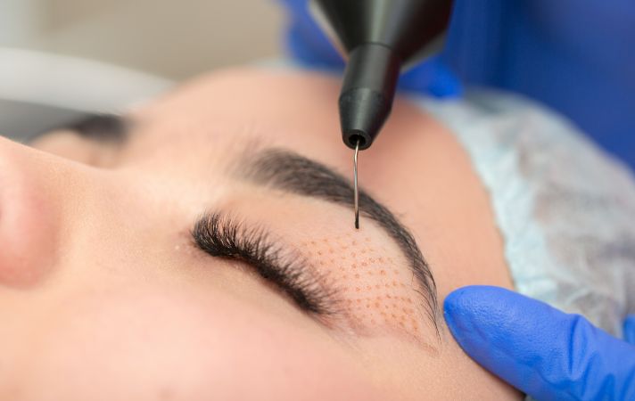 What is Blepharoplasty