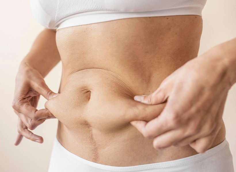 Person pinching loose abdominal skin, assessing body contour