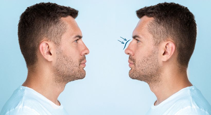 Man getting nose job