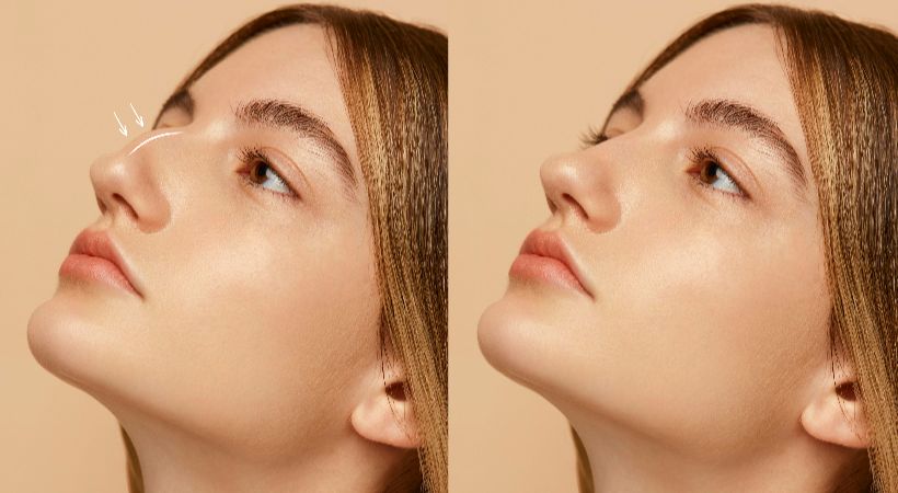 Woman getting rhinoplasty