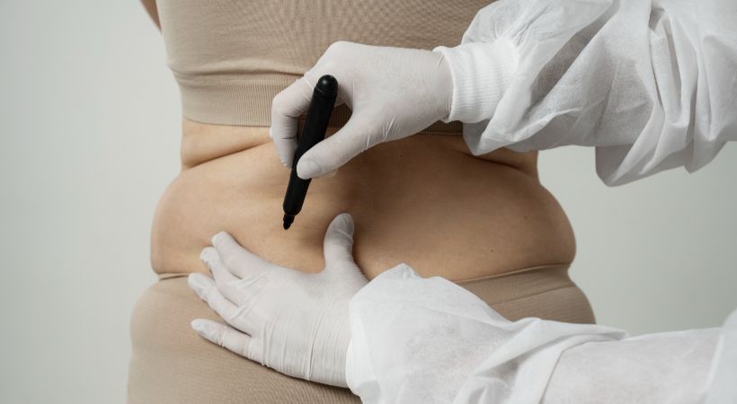 Someone being prepped for liposuction