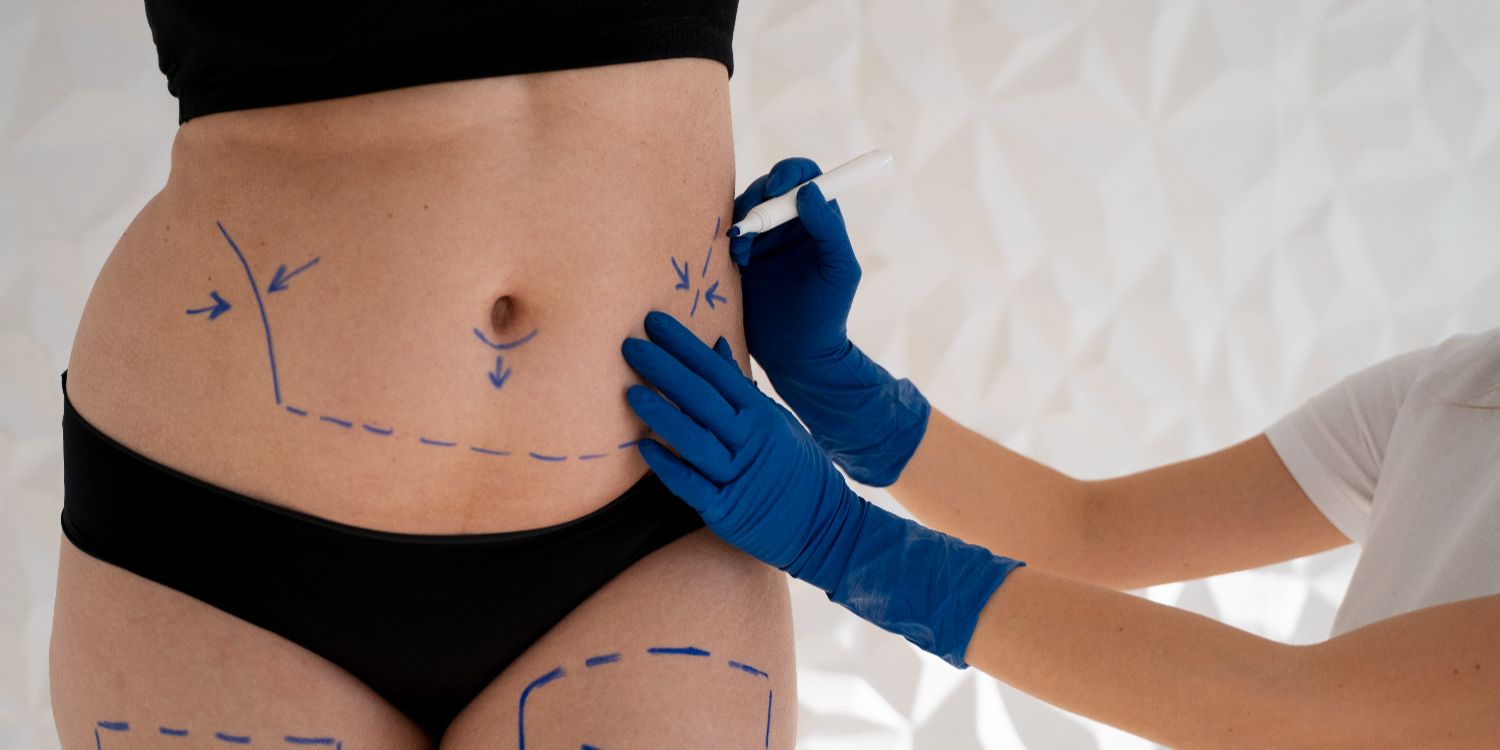Person prepped for liposuction