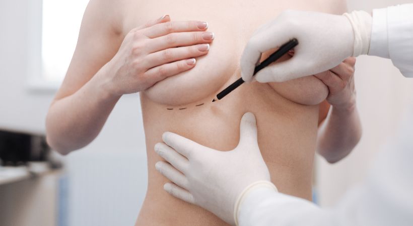 being marked for breast reduction surgery