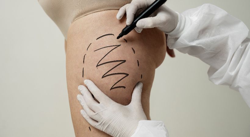 Someone being prepared for liposculpture 