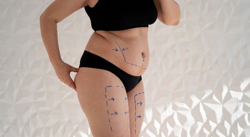 woman with marked body ready for liposuction
